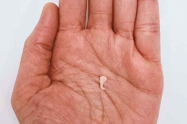 Embryo 4, 5 or 6 weeks