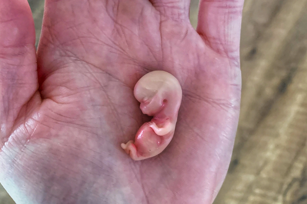 Embryo 9 weeks