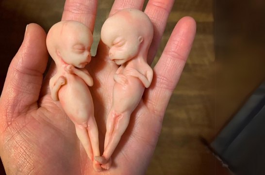 Embryo 11 weeks